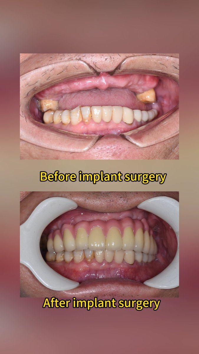 Resultados antes y después de implantes dentales en Qinghua Sunshine Dentistry (Wuhan)