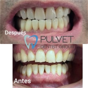 Результати до та після встановлення зубних коронок у Pulvet Dentist Group, покращена посмішка
