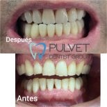 Результати до та після встановлення зубних коронок у Pulvet Dentist Group, покращена посмішка