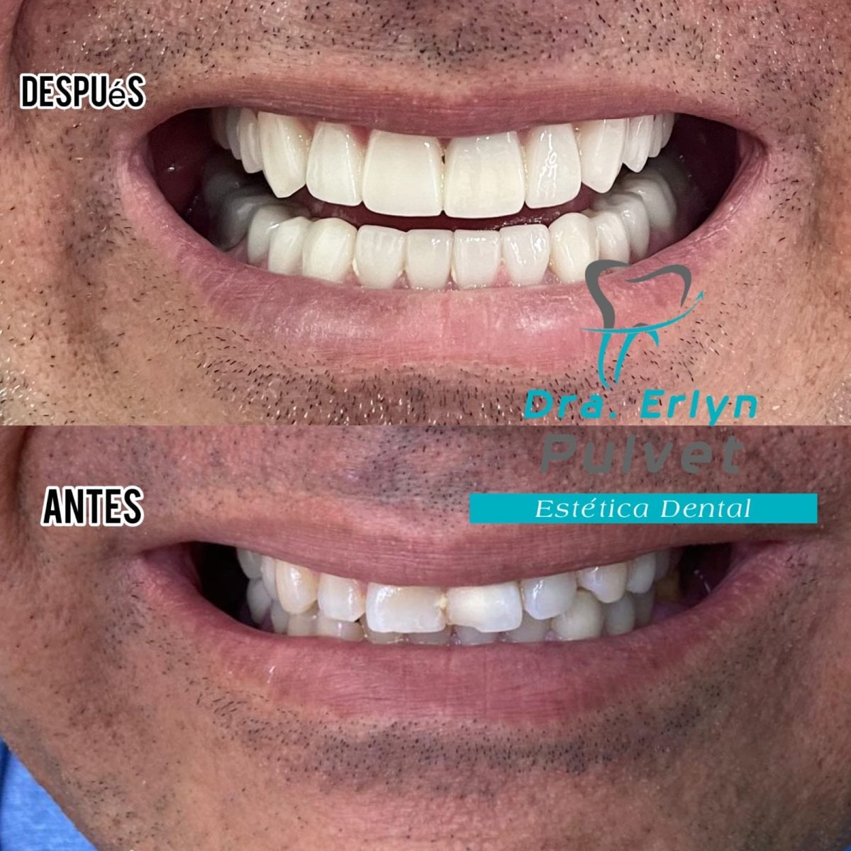 Resultados antes y después de coronas dentales en Dra. Erlyn Pulvet Estética Dental