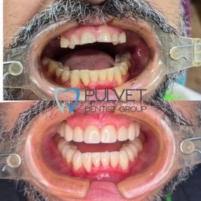 До та після встановлення зубних коронок у Pulvet Dentist Group, відновлена посмішка