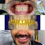 Результати до і після встановлення зубних коронок – трансформація усмішки в клініці