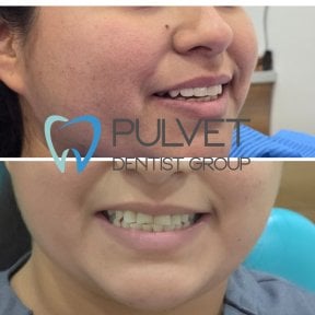 Результати до і після встановлення коронок у Pulvet Dentist Group, покращена посмішка