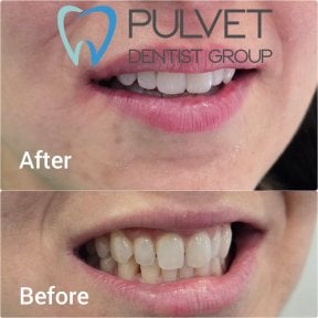 Результати до і після встановлення коронок у Pulvet Dentist Group, покращена посмішка