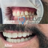 Результати Hollywood Smile до і після в Pulvet Dentist Group – трансформація вінірами