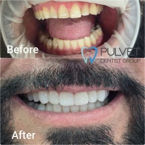 Результати Hollywood Smile до і після в Pulvet Dentist Group – помітне перетворення усмішки