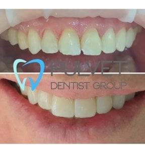 Результати до і після Hollywood Smile з вінірами у клініці Pulvet Dentist Group