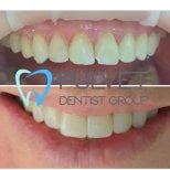 Результати до і після Hollywood Smile з вінірами у клініці Pulvet Dentist Group