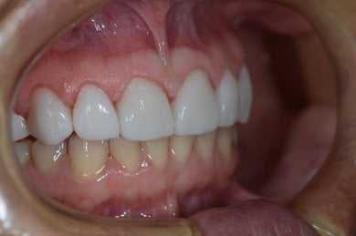 Результат Hollywood Smile з вінірами – білі, рівні зуби після процедури