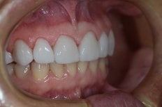 Результат Hollywood Smile з вінірами – білі, рівні зуби після процедури
