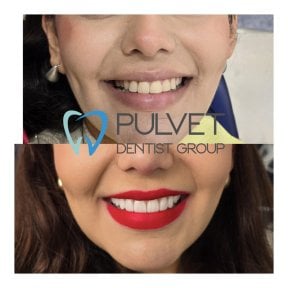 Результати до і після Hollywood Smile у Pulvet Dentist Group – трансформація вінірами