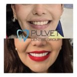Результати до і після Hollywood Smile у Pulvet Dentist Group – трансформація вінірами