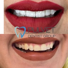 Результати до і після Hollywood Smile з вінірами у Pulvet Dentist Group