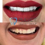 Результати до і після Hollywood Smile з вінірами у Pulvet Dentist Group