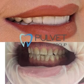 Результати до і після Hollywood Smile у Pulvet Dentist Group – трансформація вінірами