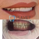 Результати до і після Hollywood Smile у Pulvet Dentist Group – трансформація вінірами