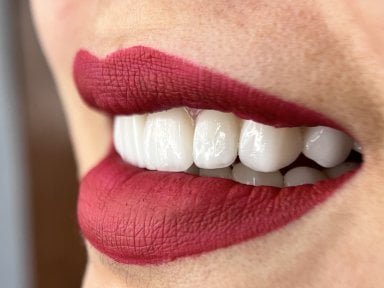 Результат Hollywood Smile з вінірами – білі рівні зуби після процедури