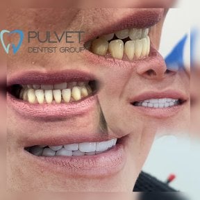 Результати до і після Hollywood Smile у Pulvet Dentist Group – трансформація вінірами