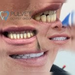Результати до і після Hollywood Smile у Pulvet Dentist Group – трансформація вінірами