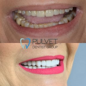 Результати до та після Hollywood Smile у Pulvet Dentist Group – білі, рівні зуби