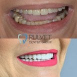 Результати до та після Hollywood Smile у Pulvet Dentist Group – білі, рівні зуби