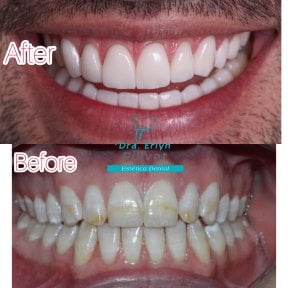 Результати до і після Hollywood Smile у клініці Estética Dental – білі рівні зуби