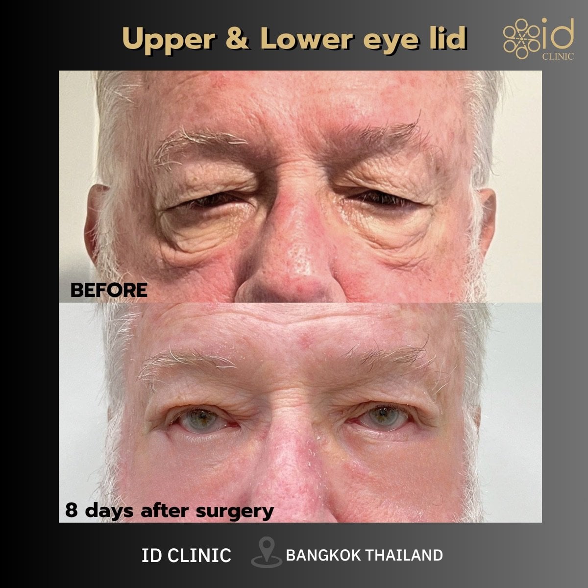 نتائج رأب الجفن السفلي قبل وبعد في ID Clinic Bangkok، تقليل انتفاخ أسفل العين