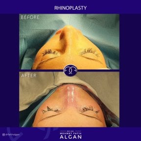 Efekty przed i po rhinoplastyce w klinice Dr. Safa Manav, widoczna korekta nosa