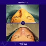 Efekty przed i po rhinoplastyce w klinice Dr. Safa Manav, widoczna korekta nosa