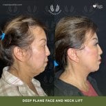 Результаты до и после deep plane SMAS лифтинга лица и шеи в клинике Dr. Safa Manav