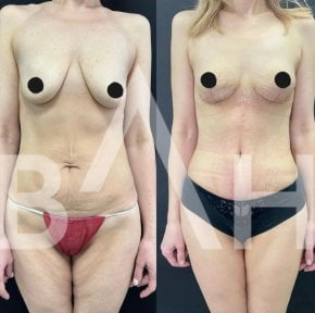 before-after photo tightening-of-facial-skin-facelift