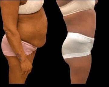 Результаты до и после mommy makeover в Hisar Hospital Intercontinental, коррекция фигуры