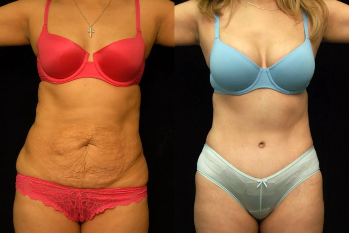 نتائج قبل وبعد عملية تجميل الأم في مستشفى هيسار – تنسيق القوام