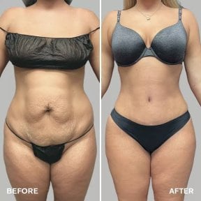 Результаты до и после mommy makeover в Hisar Hospital Intercontinental, коррекция фигуры