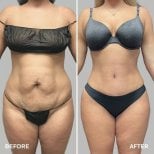 Результаты до и после mommy makeover в Hisar Hospital Intercontinental, коррекция фигуры