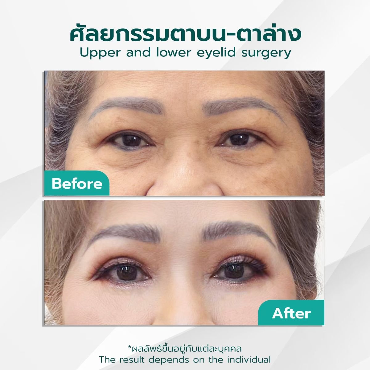 before-after photo