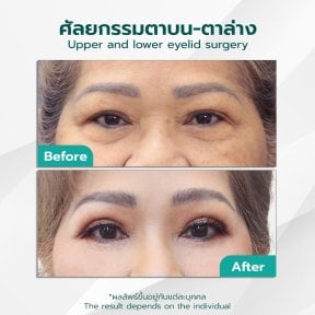 before-after photo lower-eyelid-surgery
