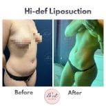 Efekty hi-def liposukcji przed i po w Db'est Clinic, widoczna poprawa sylwetki