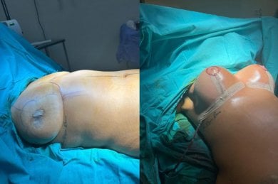 before-after photo breast-augmentation