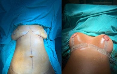 before-after photo breast-augmentation