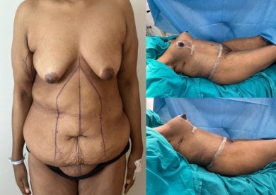 before-after photo breast-augmentation