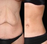 Résultats avant/après mommy makeover à Memorial Şişli Hospital, ventre raffermi