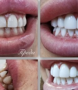 Before and after dental bonding results at AllDental, improved smile and whiter teeth