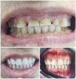 Resultados de antes y después de bonding dental en AllDental: mejor color y alineación dental