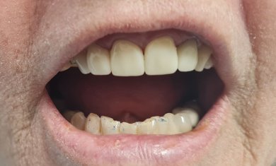 before-after photo lumineer