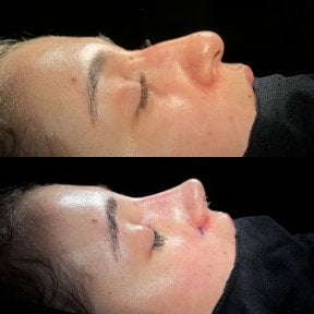 Resultados de rinoplastia antes y después, remodelación nasal para mejor perfil