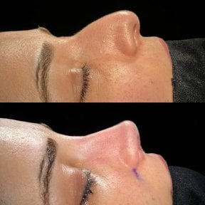 Resultados de rinoplastia antes y después, perfil y contorno nasal mejorados