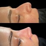 Resultados de rinoplastia antes y después, perfil y contorno nasal mejorados