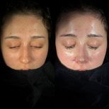 Resultados de rinoplastia antes y después, remodelación y mejora del contorno nasal