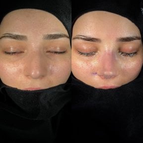 Resultados de rinoplastia antes y después, remodelación nasal natural en la clínica